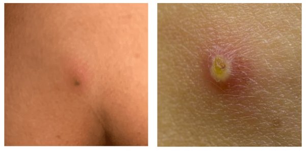  علائم ظاهری کیست مویی