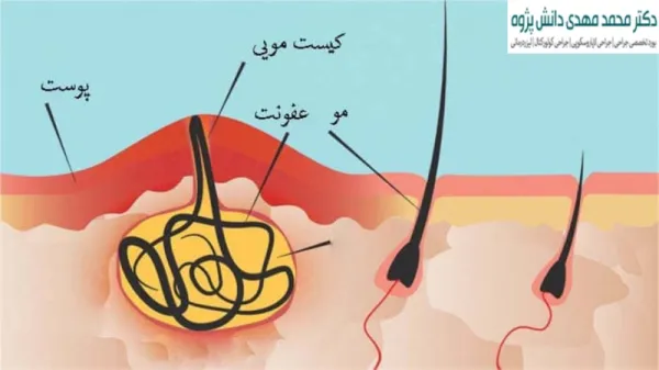 علائم ظاهری کیست مویی