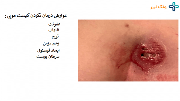  علائم ظاهری کیست مویی