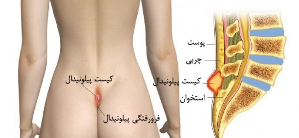  علائم ظاهری کیست مویی