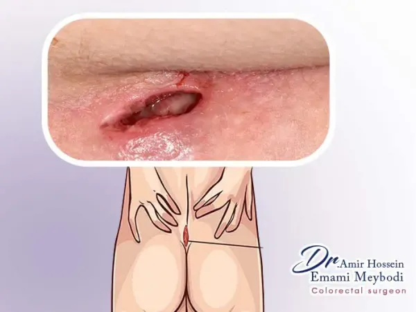  فیلم ترکیدن کیست مویی