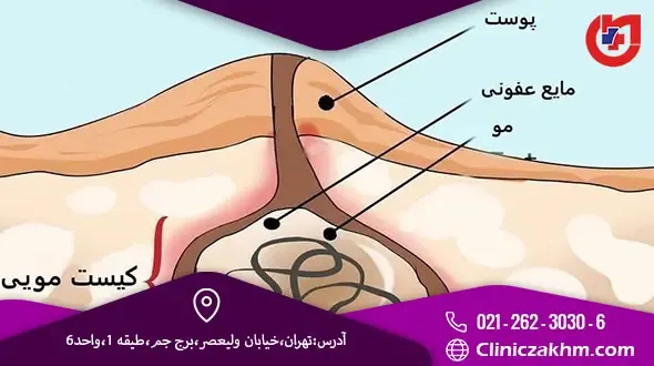  فیلم ترکیدن کیست مویی