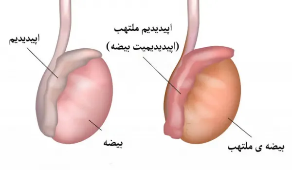  عکس و فیلم کیست بیضه