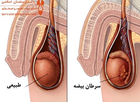  عکس و فیلم کیست بیضه