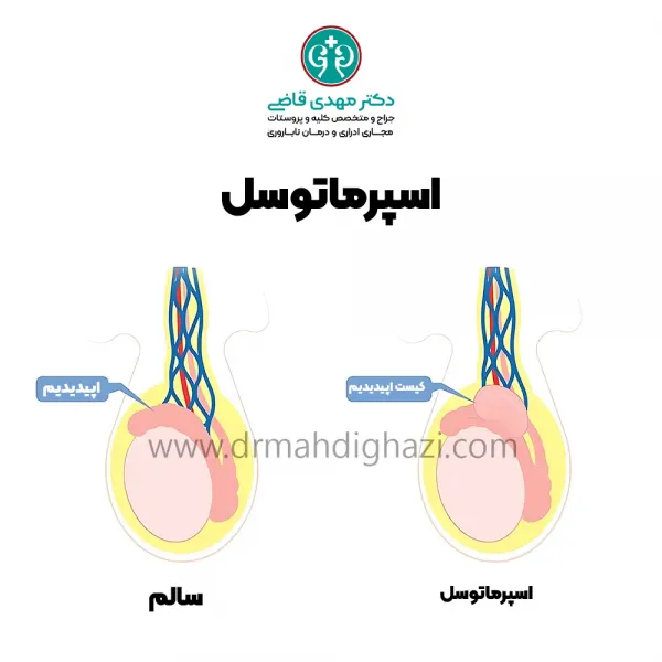  عکس و فیلم کیست بیضه