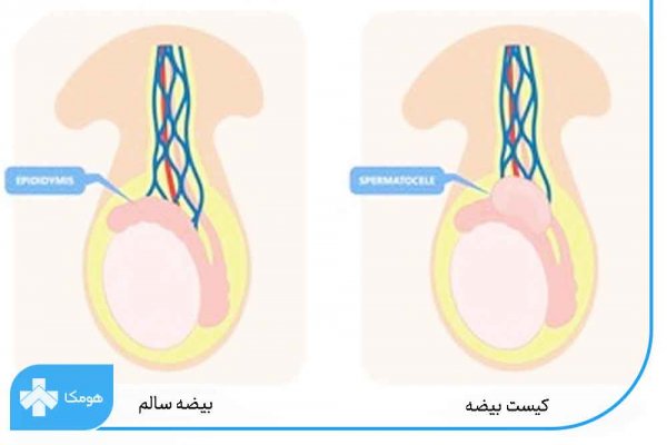  عکس و فیلم کیست بیضه