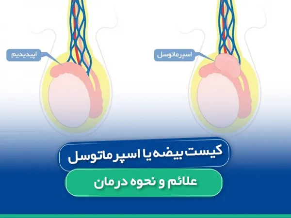 درمان قطعی کیست بیضه