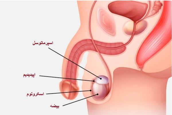  درمان قطعی کیست بیضه