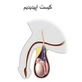  درمان قطعی کیست بیضه