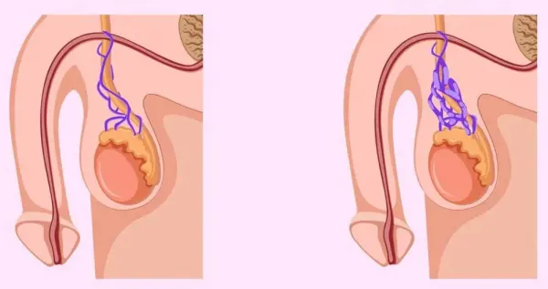  عوارض کیست بیضه