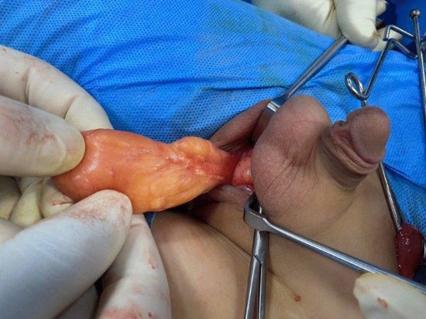  عوارض کیست بیضه