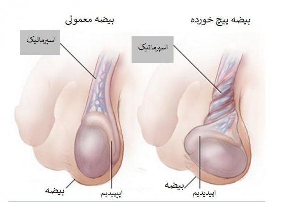  انواع کیست بیضه