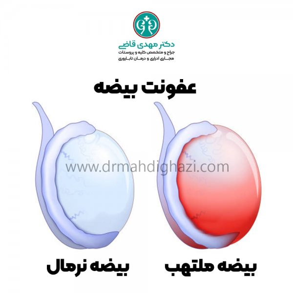  انواع کیست بیضه