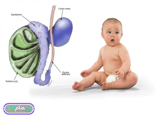 آیا کیست بیضه باعث ناباروری / نازایی میشود؟