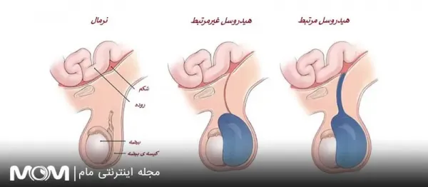  آیا کیست بیضه باعث ناباروری / نازایی میشود؟