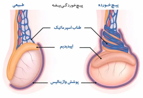  آیا کیست بیضه باعث ناباروری / نازایی میشود؟