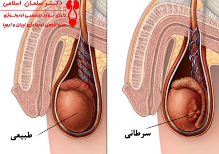  چرا یکی از بیضه ها بزرگتر است؟