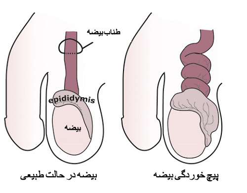  درد بیضه چپ نشانه چیست؟