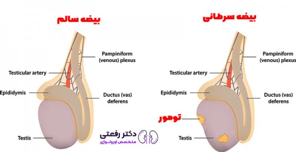  درد بیضه چپ نشانه چیست؟