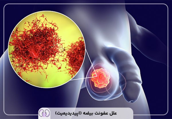  درمان عفونت بیضه چقدر طول می کشد؟