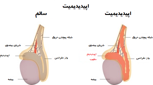  درمان عفونت بیضه چقدر طول می کشد؟