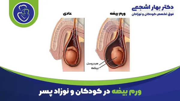 عکس ورم بیضه در کودکان