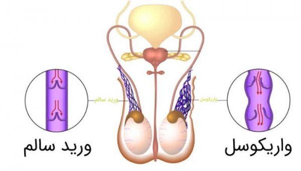  عکس ورم بیضه در کودکان