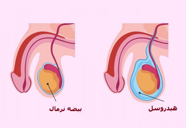  عکس ورم بیضه در کودکان