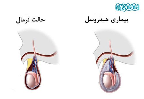  تورم بالای بیضه سمت چپ+تورم بالای بیضه سمت راست