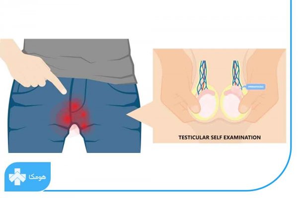 آیا کیست بیضه خود به خود از بین میرود؟