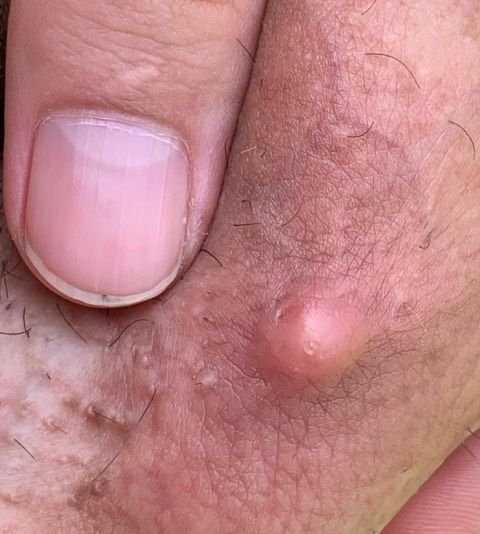  آیا کیست بیضه خود به خود از بین میرود؟