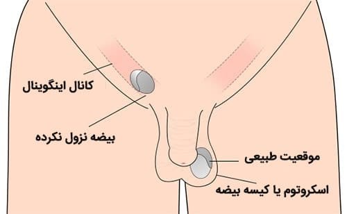  هیدروسل بیضه / آب آوردن بیضه یعنی چه؟
