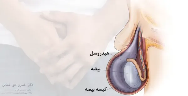  هیدروسل بیضه / آب آوردن بیضه یعنی چه؟