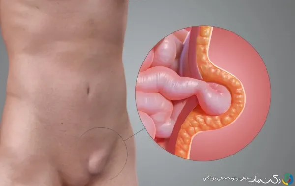  هیدروسل بیضه / آب آوردن بیضه یعنی چه؟