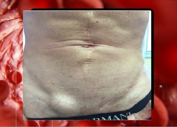  هیدروسل بیضه / آب آوردن بیضه یعنی چه؟