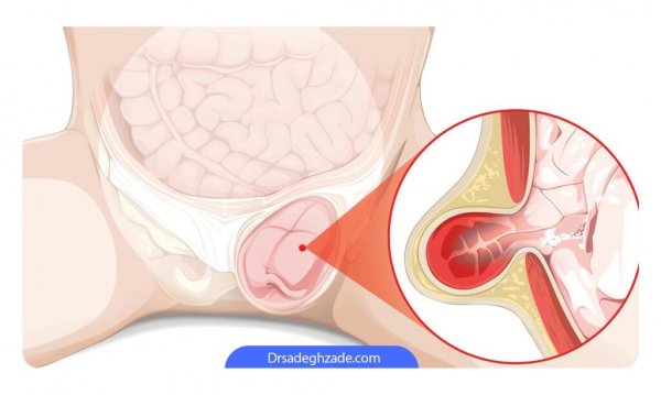  هیدروسل بیضه / آب آوردن بیضه یعنی چه؟