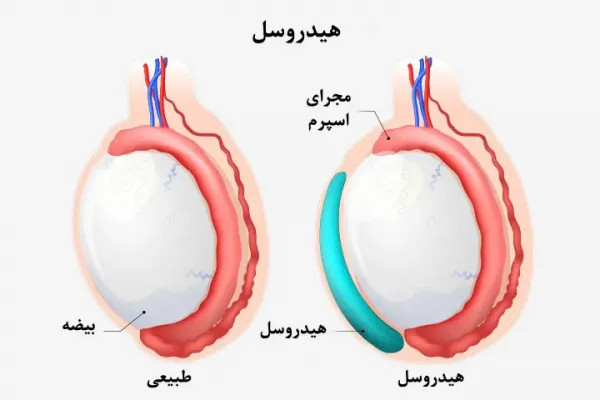  هیدروسل بیضه / آب آوردن بیضه یعنی چه؟
