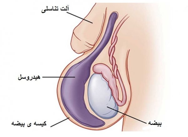  هیدروسل بیضه / آب آوردن بیضه یعنی چه؟