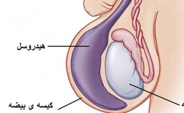  هزینه عمل هیدروسل چقدر است؟