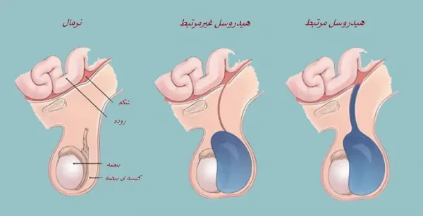  هزینه عمل هیدروسل چقدر است؟
