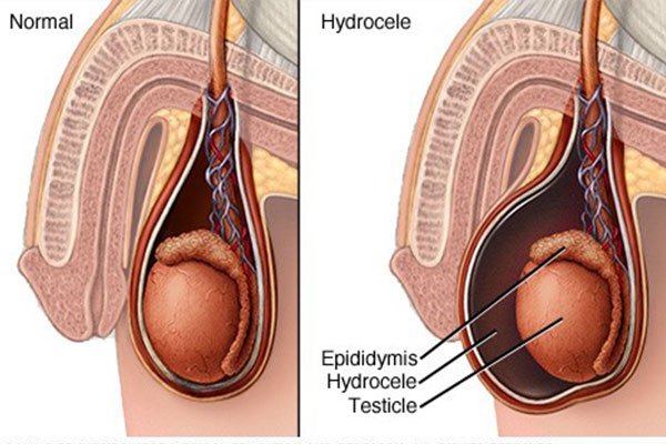  هیدروسل چگونه به وجود می آید؟