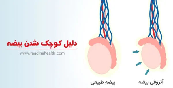  آیا ورم بیضه باعث ناباروری میشود؟