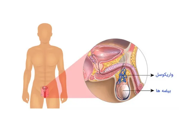  چه چیزی باعث عقیم شدن مرد میشود؟