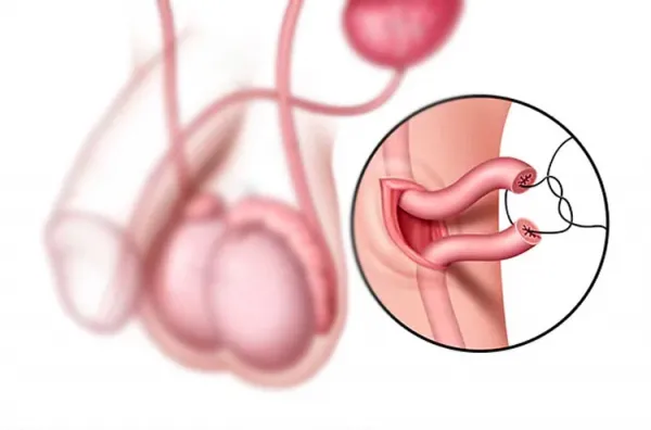 بستن لوله در مردان چه عوارضی دارد؟