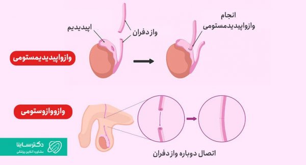  بستن لوله در مردان چه عوارضی دارد؟
