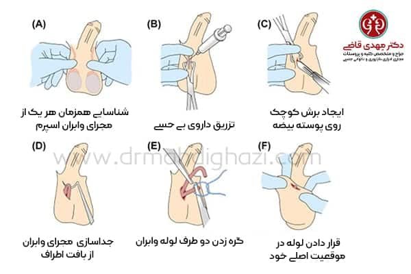  بستن لوله در مردان چه عوارضی دارد؟