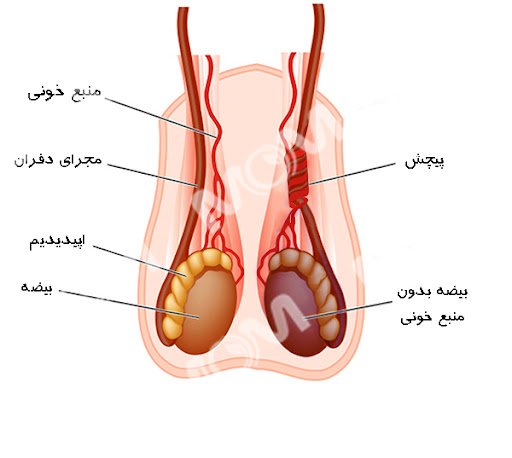  هزینه بستن لوله در مردان