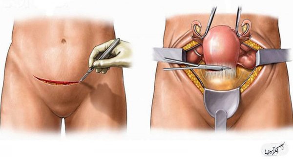 بستن لوله در مردان بهتر است یا زنان