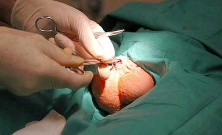  عکس و فیلم بستن لوله مردان