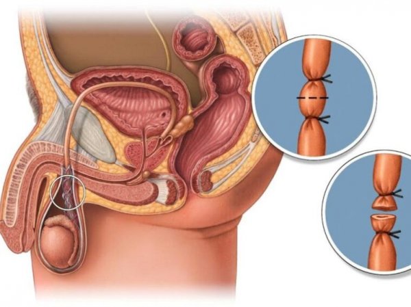 عکس و فیلم بستن لوله مردان